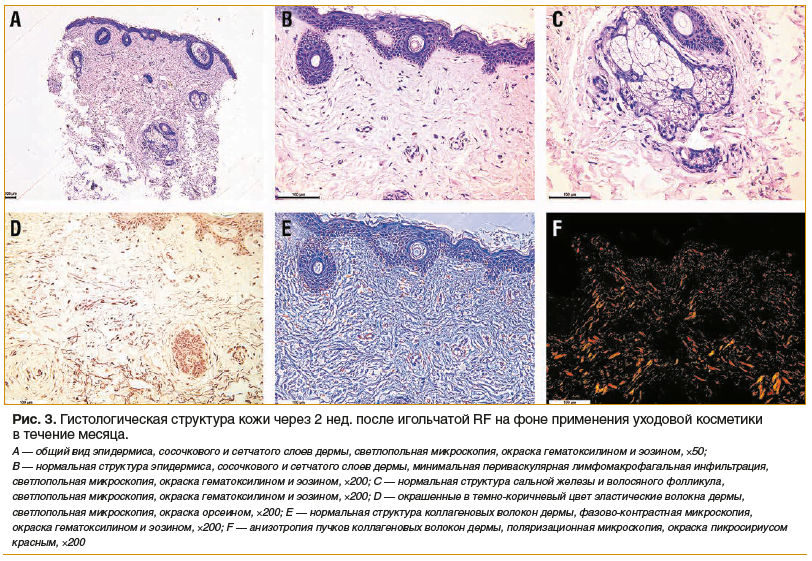 Рис. 3. Гистологическая структура кожи через 2 нед. после игольчатой RF на фоне применения уходовой косметики в течение месяца