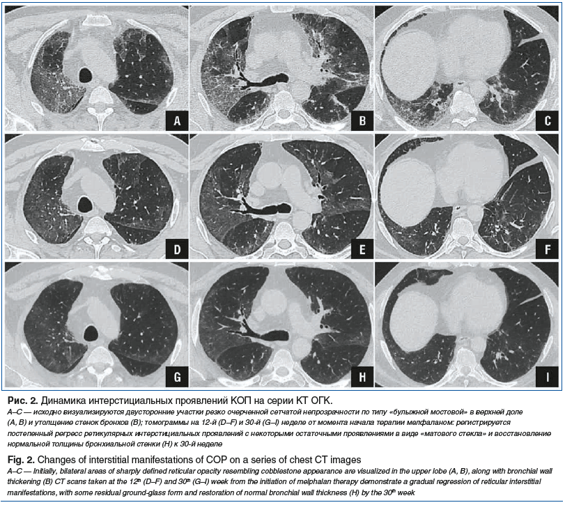 Рис. 2. Динамика интерстициальных проявлений КОП на серии КТ ОГК. A–C — исходно визуализируются двусторонние участки резко очерченной сетчатой непрозрачности по типу «булыжной мостовой» в верхней доле (A, B) и утолщение стенок бронхов (B); томограммы на 1