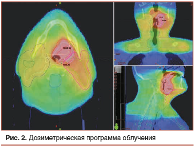 Рис. 2. Дозиметрическая программа облучения