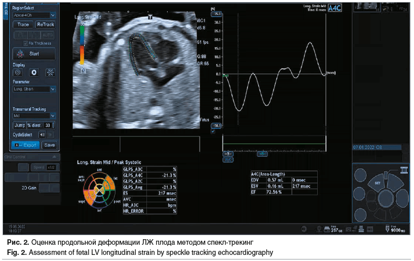 Рис. 2. Оценка продольной деформации ЛЖ плода методом спекл-трекинг Fig. 2. Assessment of fetal LV longitudinal strain by speckle tracking echocardiography