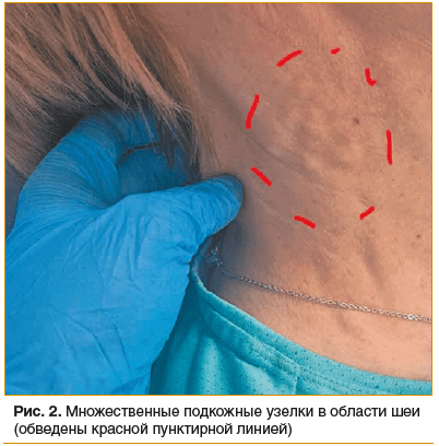 Рис. 2. Множественные подкожные узелки в области шеи (обведены красной пунктирной линией)