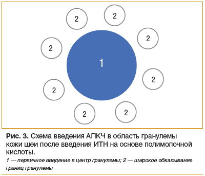 Рис. 3. Схема введения АПКЧ в область гранулемы кожи шеи после введения ИТН на основе полимолочной кислоты.