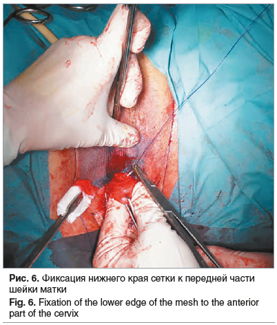 Рис. 6. Фиксация нижнего края сетки к передней части шейки матки Fig. 6. Fixation of the lower edge of the mesh to the anterior part of the cervix