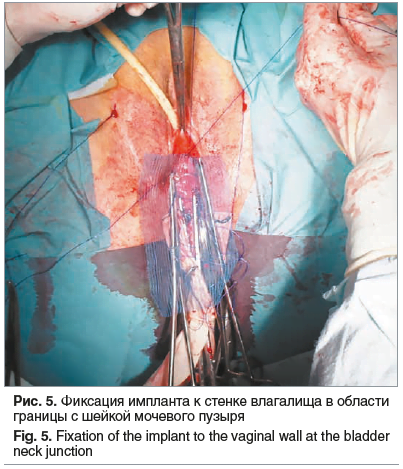 Рис. 5. Фиксация импланта к стенке влагалища в области границы с шейкой мочевого пузыря Fig. 5. Fixation of the implant to the vaginal wall at the bladder neck junction