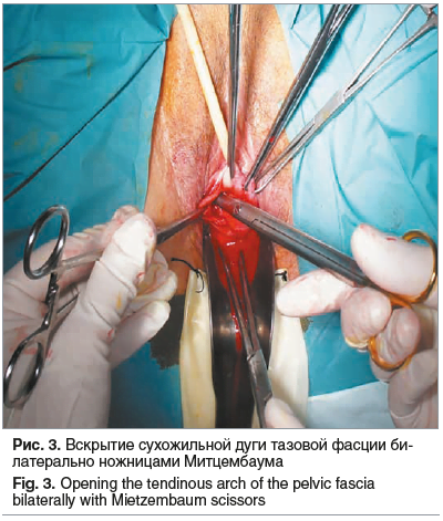 Рис. 3. Вскрытие сухожильной дуги тазовой фасции би- латерально ножницами Митцембаума Fig. 3. Opening the tendinous arch of the pelvic fascia bilaterally with Mietzembaum scissors