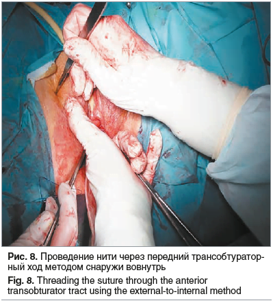 Рис. 8. Проведение нити через передний трансобтуратор- ный ход методом снаружи вовнутрь Fig. 8. Threading the suture through the anterior transobturator tract using the external-to-internal method