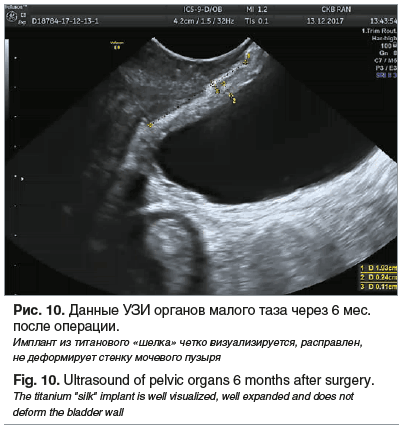 Рис. 10. Данные УЗИ органов малого таза через 6 мес. после операции. Имплант из титанового «шелка» четко визуализируется, расправлен, не деформирует стенку мочевого пузыря Fig. 10. Ultrasound of pelvic organs 6 months after surgery. The titanium 