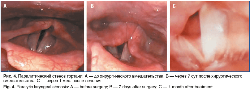 Рис. 4. Паралитический стеноз гортани: A — до хирургического вмешательства; B — через 7 сут после хирургического вмешательства; C — через 1 мес. после лечения Fig. 4. Paralytic laryngeal stenosis: А — before surgery; В — 7 days after surgery; С — 1 month 