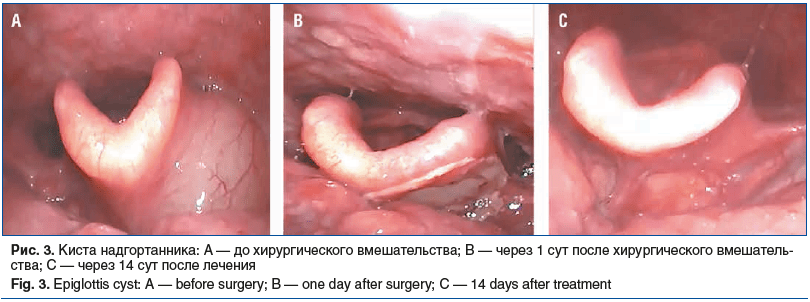 Рис. 3. Киста надгортанника: A — до хирургического вмешательства; B — через 1 cут после хирургического вмешатель- ства; C — через 14 сут после лечения Fig. 3. Epiglottis cyst: А — before surgery; В — one day after surgery; С — 14 days after treatment