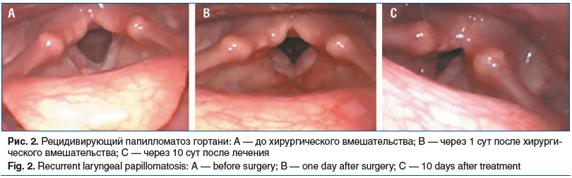 Рис. 2. Рецидивирующий папилломатоз гортани: А — до хирургического вмешательства; В — через 1 сут после хирурги- ческого вмешательства; С — через 10 сут после лечения Fig. 2. Recurrent laryngeal papillomatosis: А — before surgery; В — one day after surger