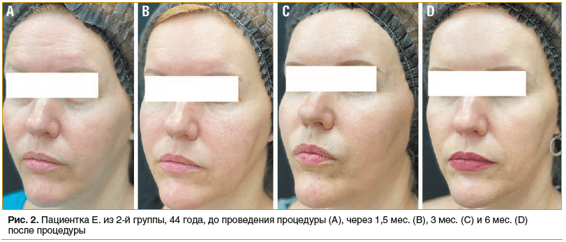 Рис. 2. Пациентка Е. из 2-й группы, 44 года, до проведения процедуры (A), через 1,5 мес. (B), 3 мес. (C) и 6 мес. (D) после процедуры