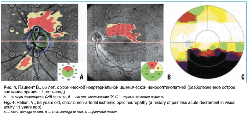 Рис. 4. Пациент В., 55 лет, с хронической неартериальной ишемической нейрооптикопатией (безболезненное острое снижение зрения 11 лет назад). А — паттерн повреждения СНВ сетчатки, В — паттерн повреждения ГК, С — периметрические дефекты Fig. 4. Patient V., 