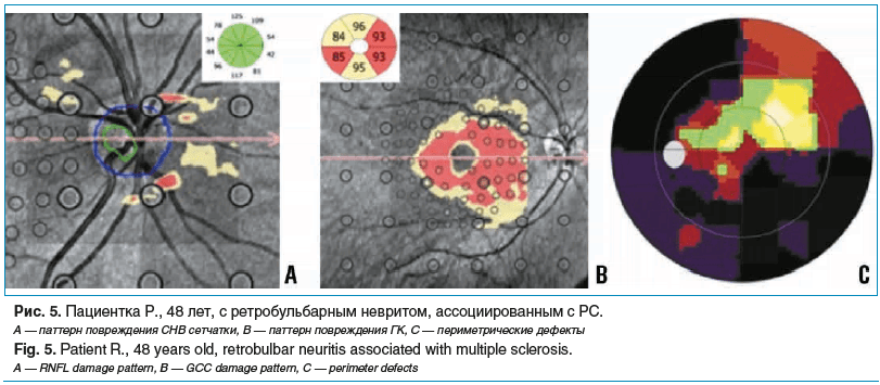 Рис. 5. Пациентка Р., 48 лет, с ретробульбарным невритом, ассоциированным с РС. А — паттерн повреждения СНВ сетчатки, В — паттерн повреждения ГК, С — периметрические дефекты Fig. 5. Patient R., 48 years old, retrobulbar neuritis associated with multiple s