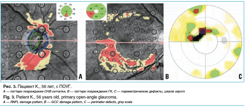 Рис. 3. Пациент К., 56 лет, с ПОУГ. А — паттерн повреждения СНВ сетчатки, В — паттерн повреждения ГК, С — периметрические дефекты, шкала серого Fig. 3. Patient K., 56 years old, primary open-angle glaucoma. A — RNFL damage pattern, B — GCC damage pattern,