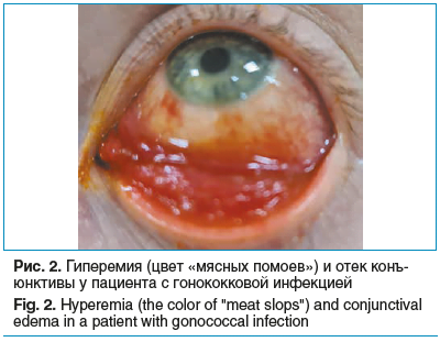 Рис. 2. Гиперемия (цвет «мясных помоев») и отек конъ- юнктивы у пациента с гонококковой инфекцией Fig. 2. Hyperemia (the color of 