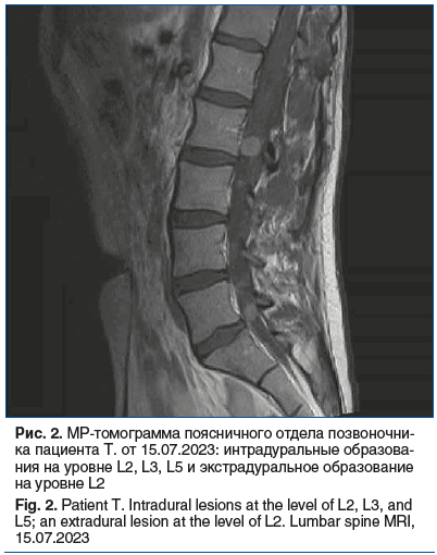 Рис. 2. МР-томограмма поясничного отдела позвоночни- ка пациента Т. от 15.07.2023: интрадуральные образова- ния на уровне L2, L3, L5 и экстрадуральное образование на уровне L2 Fig. 2. Patient T. Intradural lesions at the level of L2, L3, and L5; an extrad