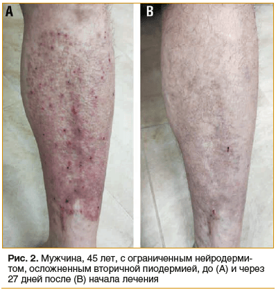 Рис. 2. Мужчина, 45 лет, с ограниченным нейродерми- том, осложненным вторичной пиодермией, до (А) и через 27 дней после (В) начала лечения