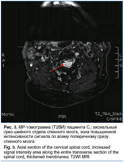 Рис. 3. МР-томограмма (T2ВИ) пациента С.: аксиальный срез шейного отдела спинного мозга, зона повышенной интенсивности сигнала по всему поперечному срезу спинного мозга Fig. 3. Axial section of the cervical spinal cord, increased signal intensity area alo