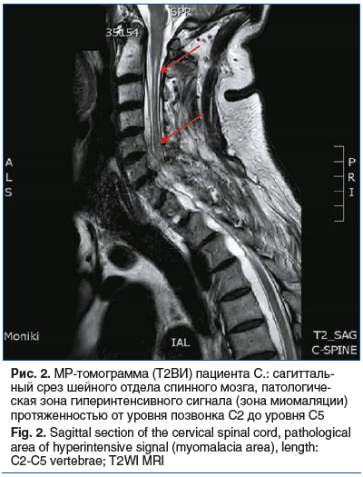 Рис. 2. МР-томограмма (T2ВИ) пациента С.: сагитталь- ный срез шейного отдела спинного мозга, патологиче- ская зона гиперинтенсивного сигнала (зона миомаляции) протяженностью от уровня позвонка С2 до уровня С5 Fig. 2. Sagittal section of the cervical spina