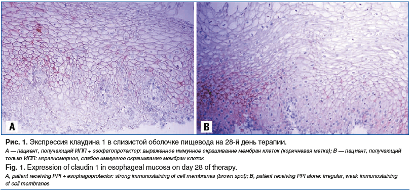 Рис. 1. Экспрессия клаудина 1 в слизистой оболочке пищевода на 28-й день терапии. А — пациент, получающий ИПП + эзофагопротектор: выраженное иммунное окрашивание мембран клеток (коричневая метка); В — пациент, получающий только ИПП: неравномерное, слабое 