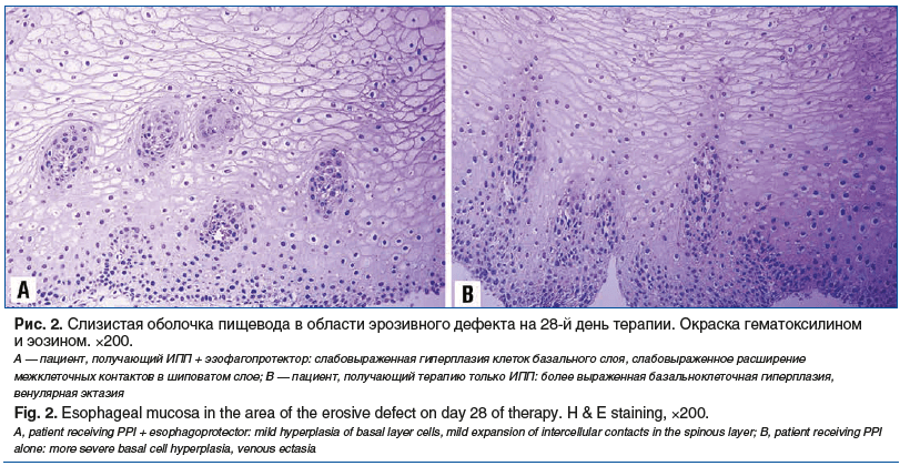 Рис. 2. Слизистая оболочка пищевода в области эрозивного дефекта на 28-й день терапии. Окраска гематоксилином и эозином. ×200. А — пациент, получающий ИПП + эзофагопротектор: слабовыраженная гиперплазия клеток базального слоя, слабовыраженное расширение м
