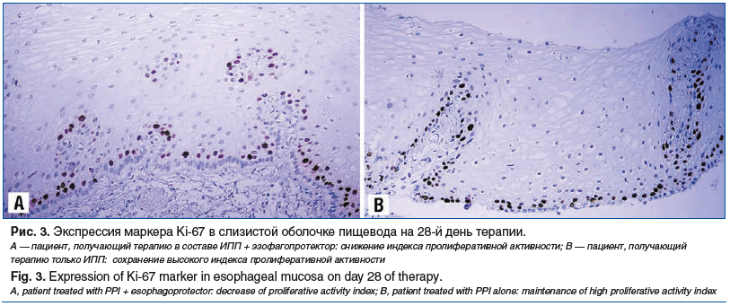Рис. 3. Экспрессия маркера Ki-67 в слизистой оболочке пищевода на 28-й день терапии. А — пациент, получающий терапию в составе ИПП + эзофагопротектор: снижение индекса пролиферативной активности; В — пациент, получающий терапию только ИПП: сохранение высо