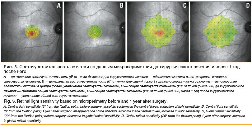 Рис. 3. Светочувствительность сетчатки по данным микропериметрии до хирургического лечения и через 1 год после него. A — центральная светочувствительность (6° от точки фиксации) до хирургического лечения — абсолютная скотома в центре фовеа, снижение свето
