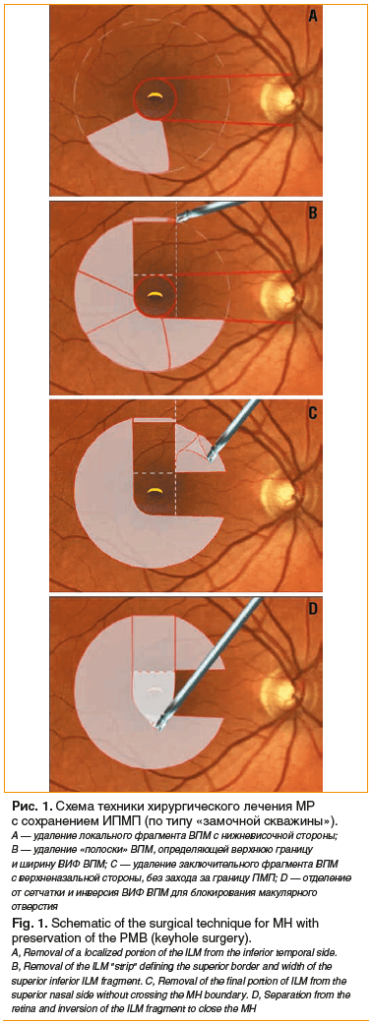 Рис. 1. Схема техники хирургического лечения МР с сохранением ИПМП (по типу «замочной скважины»). A — удаление локального фрагмента ВПМ с нижневисочной стороны; B — удаление «полоски» ВПМ, определяющей верхнюю границу и ширину ВИФ ВПМ; C — удаление заключ