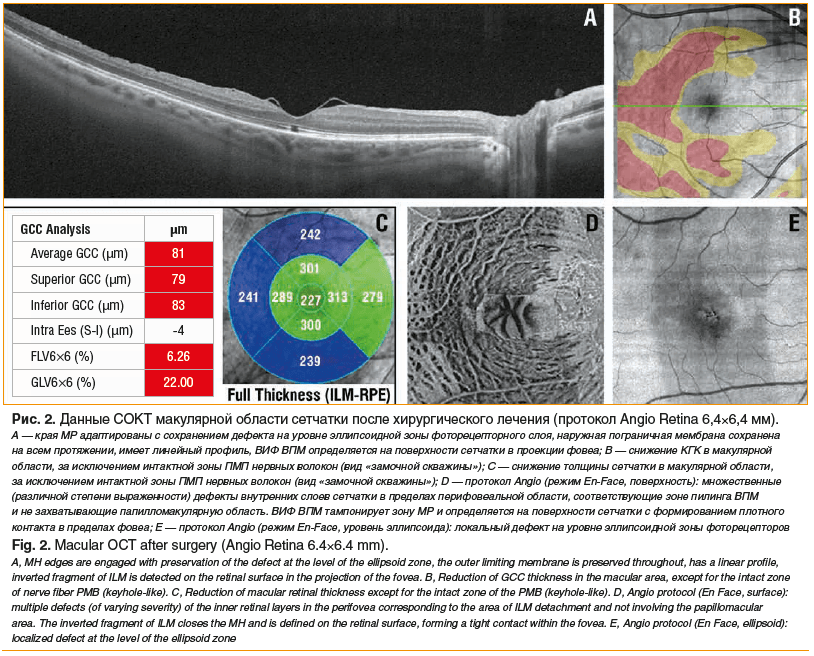 Рис. 2. Данные СОКТ макулярной области сетчатки после хирургического лечения (протокол Angio Retina 6,4×6,4 мм). A — края МР адаптированы с сохранением дефекта на уровне эллипсоидной зоны фоторецепторного слоя, наружная пограничная мембрана сохранена на в
