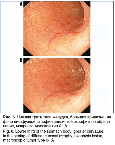 Рис. 6. Нижняя треть тела желудка, большая кривизна: на фоне диффузной атрофии слизистой экзофитное образо- вание, макроскопический тип 0-IIA Fig. 6. Lower third of the stomach body, greater curvature: in the setting of diffuse mucosal atrophy, exophytic 