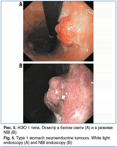 Рис. 5. НЭО 1 типа. Осмотр в белом свете (А) и в режиме NBI (В) Fig. 5. Type 1 stomach neuroendocrine tumours. White light endoscopy (A) and NBI endoscopy (B)