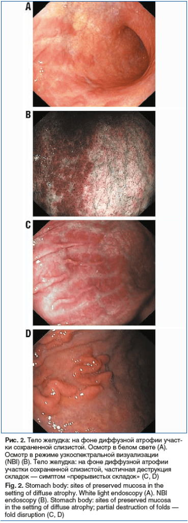 Рис. 2. Тело желудка: на фоне диффузной атрофии участ- ки сохраненной слизистой. Осмотр в белом свете (А). Осмотр в режиме узкоспектральной визуализации (NBI) (В). Тело желудка: на фоне диффузной атрофии участки сохраненной слизистой, частичная деструкция