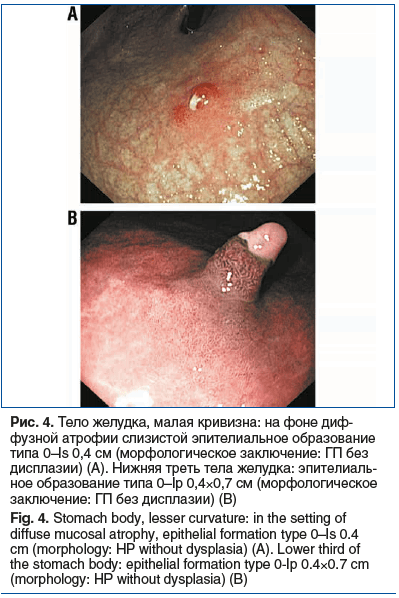 Рис. 4. Тело желудка, малая кривизна: на фоне диф- фузной атрофии слизистой эпителиальное образование типа 0–Is 0,4 см (морфологическое заключение: ГП без дисплазии) (А). Нижняя треть тела желудка: эпителиаль- ное образование типа 0–Ip 0,4×0,7 см (морфоло
