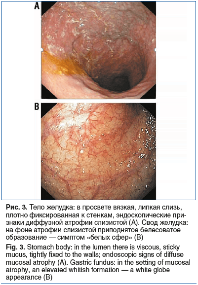 Рис. 3. Тело желудка: в просвете вязкая, липкая слизь, плотно фиксированная к стенкам, эндоскопические при- знаки диффузной атрофии слизистой (А). Свод желудка: на фоне атрофии слизистой приподнятое белесоватое образование — симптом «белых сфер» (В) Fig. 