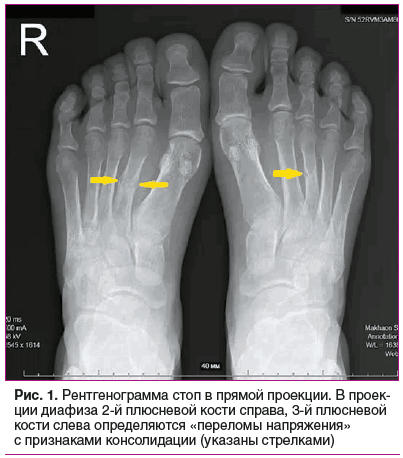 Рис. 1. Рентгенограмма стоп в прямой проекции. В проек- ции диафиза 2-й плюсневой кости справа, 3-й плюсневой кости слева определяются «переломы напряжения» с признаками консолидации (указаны стрелками)