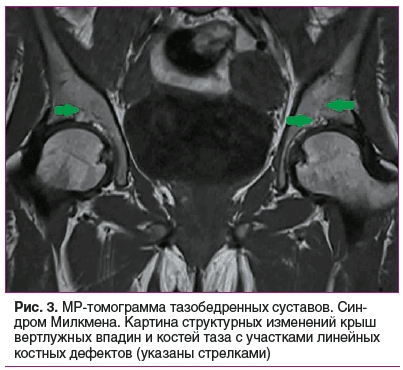 Рис. 3. МР-томограмма тазобедренных суставов. Син- дром Милкмена. Картина структурных изменений крыш вертлужных впадин и костей таза с участками линейных костных дефектов (указаны стрелками)