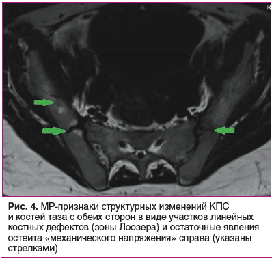 Рис. 4. МР-признаки структурных изменений КПС и костей таза с обеих сторон в виде участков линейных костных дефектов (зоны Лоозера) и остаточные явления остеита «механического напряжения» справа (указаны стрелками)