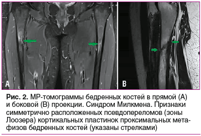 Рис. 2. МР-томограммы бедренных костей в прямой (A) и боковой (B) проекции. Синдром Милкмена. Признаки симметрично расположенных псевдопереломов (зоны Лоозера) кортикальных пластинок проксимальных метафизов бедренных костей (указаны стрелками)