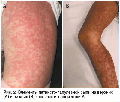 Рис. 2. Элементы пятнисто-папулезной сыпи на верхних (А) и нижних (В) конечностях пациентки А.