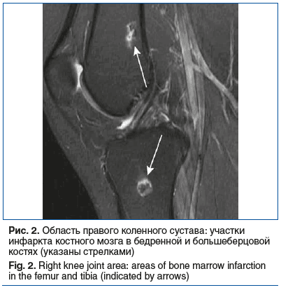 Рис. 2. Область правого коленного сустава: участки инфаркта костного мозга в бедренной и большеберцовой костях (указаны стрелками) Fig. 2. Right knee joint area: areas of bone marrow infarction in the femur and tibia (indicated by arrows)