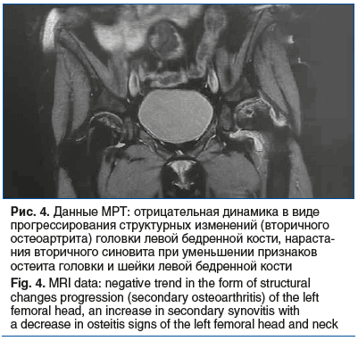 Рис. 4. Данные МРТ: отрицательная динамика в виде прогрессирования структурных изменений (вторичного остеоартрита) головки левой бедренной кости, нараста- ния вторичного синовита при уменьшении признаков остеита головки и шейки левой бедренной кости Fig. 
