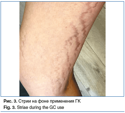 Рис. 3. Стрии на фоне применения ГК Fig. 3. Striae during the GC use