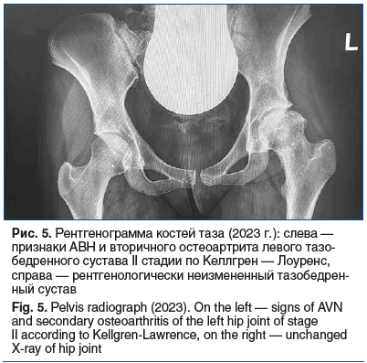 Рис. 5. Рентгенограмма костей таза (2023 г.): слева — признаки АВН и вторичного остеоартрита левого тазо- бедренного сустава II стадии по Келлгрен — Лоуренс, справа — рентгенологически неизмененный тазобедрен- ный сустав Fig. 5. Pelvis radiograph (2023). 