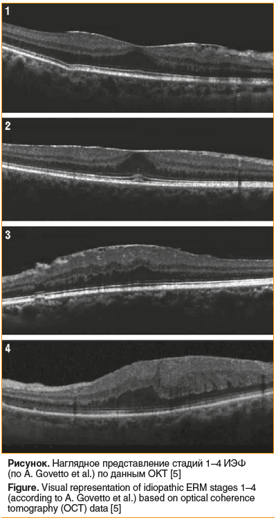 Рисунок. Наглядное представление стадий 1–4 ИЭФ (по А. Govetto et al.) по данным ОКТ [5] Figure. Visual representation of idiopathic ERM stages 1–4 (according to A. Govetto et al.) based on optical coherence tomography (OCT) data [5]