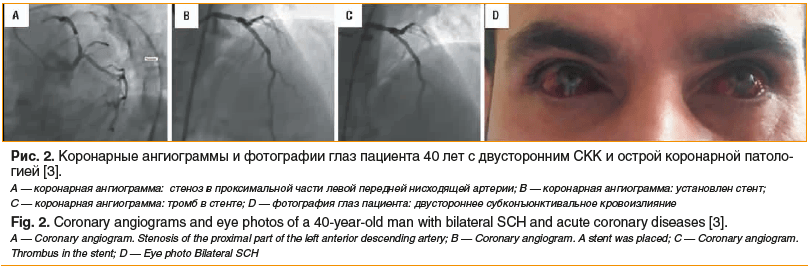 Рис. 2. Коронарные ангиограммы и фотографии глаз пациента 40 лет с двусторонним СКК и острой коронарной патоло- гией [3]. A — коронарная ангиограмма: стеноз в проксимальной части левой передней нисходящей артерии; B — коронарная ангиограмма: установлен ст