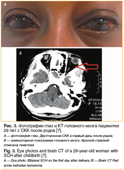Рис. 3. Фотографии глаз и КТ головного мозга пациентки 29 лет с СКК после родов [7]. А — фотография глаз. Двустороннее СКК в первый день после родов; B — компьютерная томограмма головного мозга. Красной стрелкой отмечена гематома Fig. 3. Eye photos and br