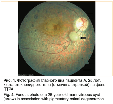 Рис. 4. Фотография глазного дна пациента А. 25 лет: киста стекловидного тела (отмечена стрелкой) на фоне ПТРА Fig. 4. Fundus photo of a 25-year-old man: vitreous cyst (arrow) in association with pigmentary retinal degeneration