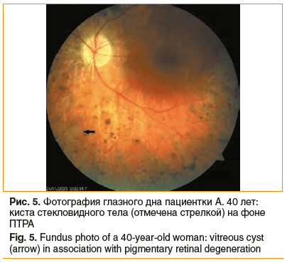 Рис. 5. Фотография глазного дна пациентки А. 40 лет: киста стекловидного тела (отмечена стрелкой) на фоне ПТРА Fig. 5. Fundus photo of a 40-year-old woman: vitreous cyst (arrow) in association with pigmentary retinal degeneration