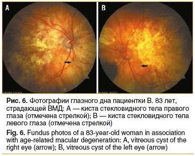 Рис. 6. Фотографии глазного дна пациентки В. 83 лет, страдающей ВМД: А — киста стекловидного тела правого глаза (отмечена стрелкой); В — киста стекловидного тела левого глаза (отмечена стрелкой) Fig. 6. Fundus photos of a 83-year-old woman in association 