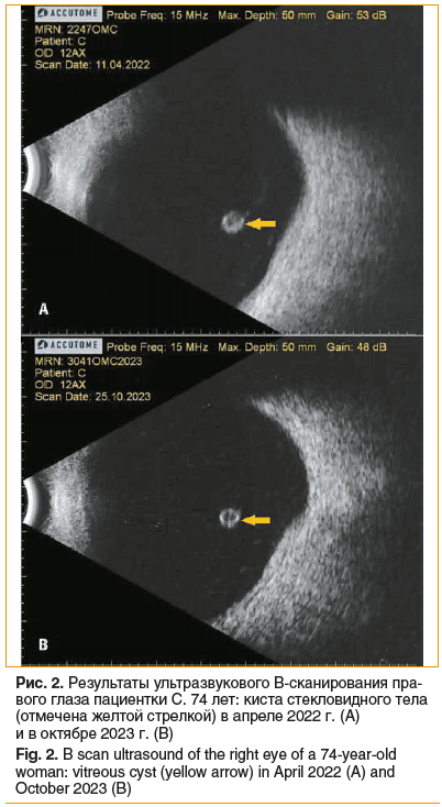 Рис. 2. Результаты ультразвукового В-сканирования пра- вого глаза пациентки С. 74 лет: киста стекловидного тела (отмечена желтой стрелкой) в апреле 2022 г. (А) и в октябре 2023 г. (В) Fig. 2. B scan ultrasound of the right eye of a 74-year-old woman: vitr